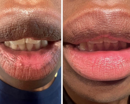 Mavella™ Dark lips Cream